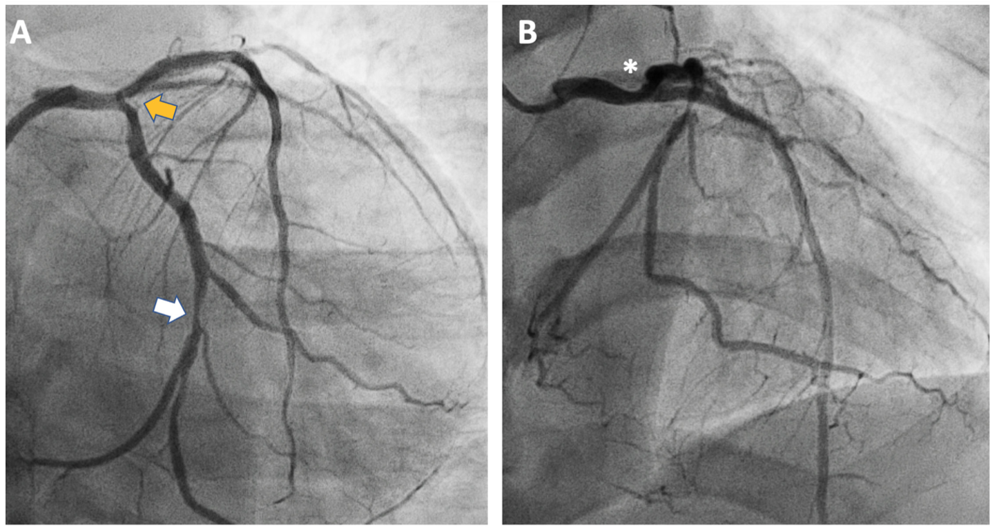 Ostial Circumflex Dissection Caused by Off-Track OCT Catheter